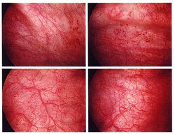 沈阳男性膀胱炎的防治指南
